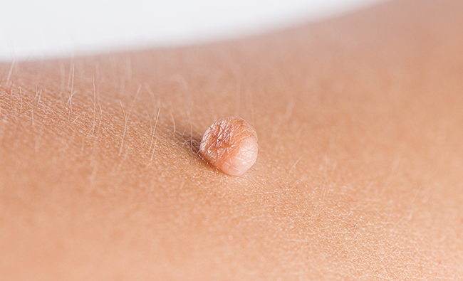 Skin Tags (Acrochordon): Causes and Treatment