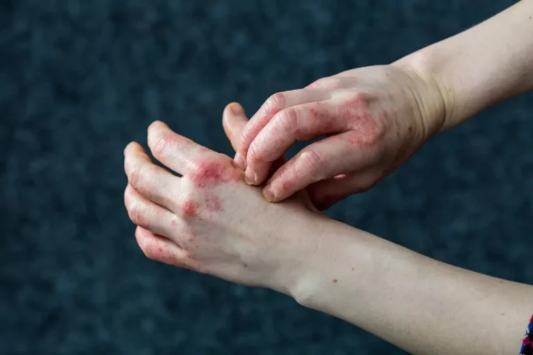A close up of a man's hands affected by eczema, he is picking at the affected skin.