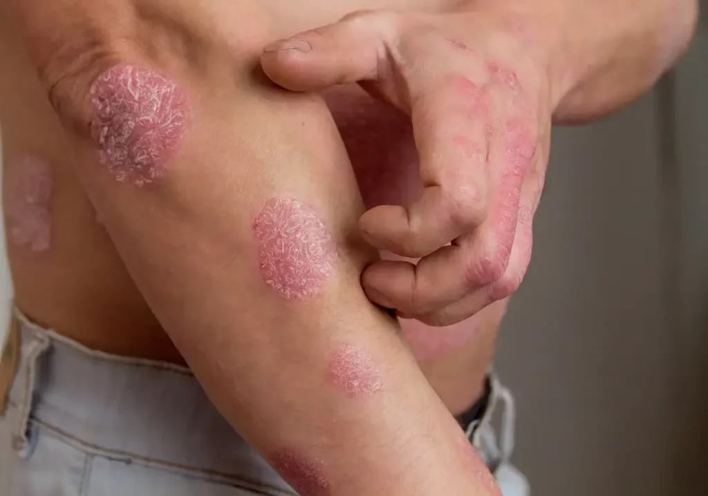 A close up photo of a man scratching his arm. He has psoriasis on his arms and hand.