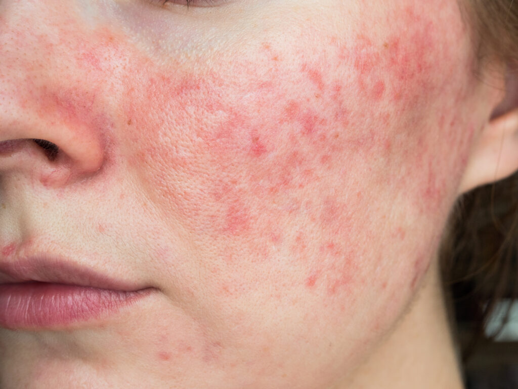 A close up photo of a woman's face, se is suffering from rosacea which gives a pink tinge to the affect skin, similar to acne