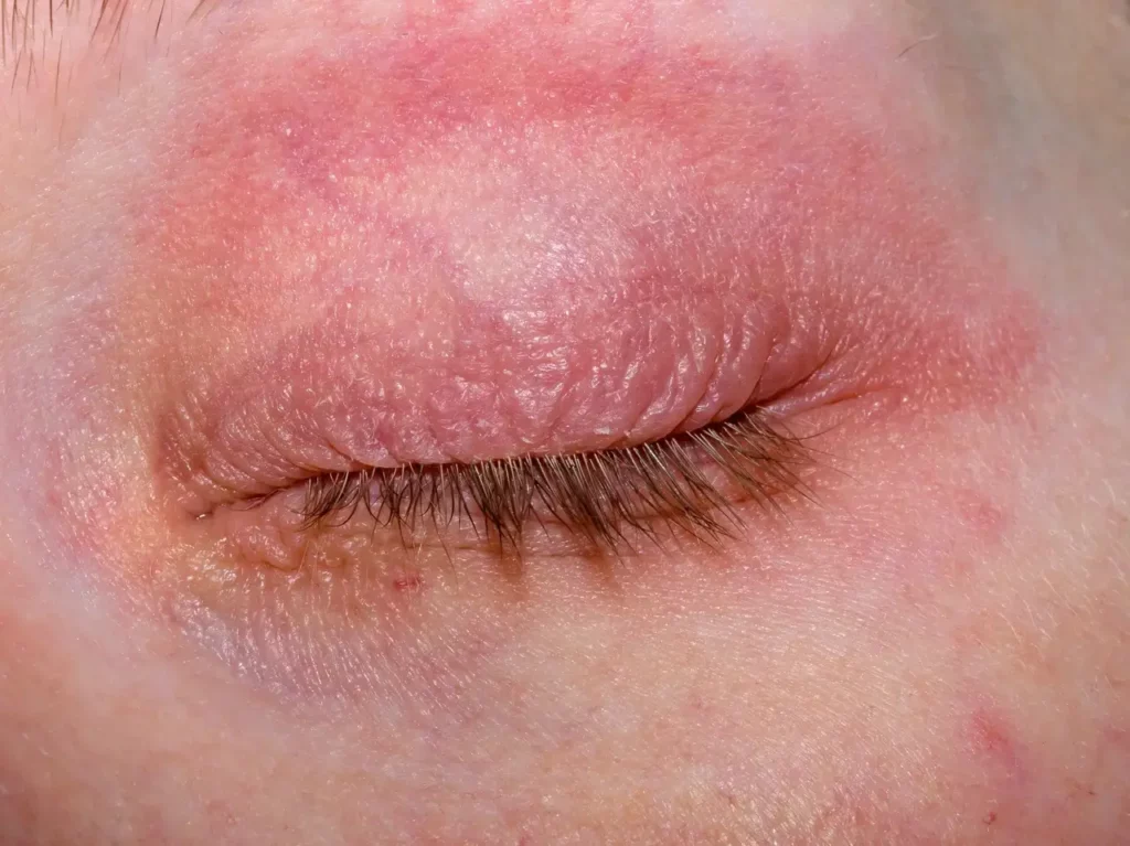 A close up photo of a woman's eye, the surrounding skin is highly inflamed and red due to eczema