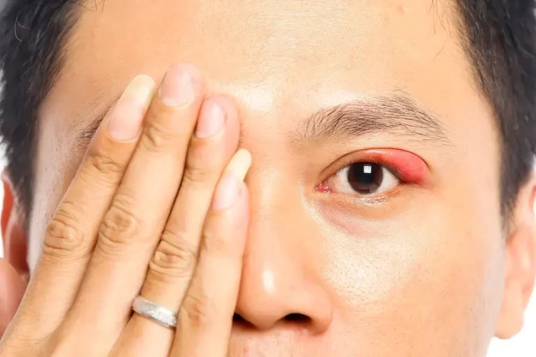 A close-up photo of a woman covering an eye with her hand, ther visible eye has a stye on the upper eyelid which is very swollen and red.