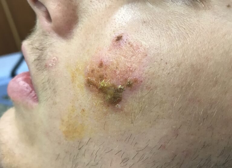 A man's face with yellow-crusted impetigo sores on the left cheek