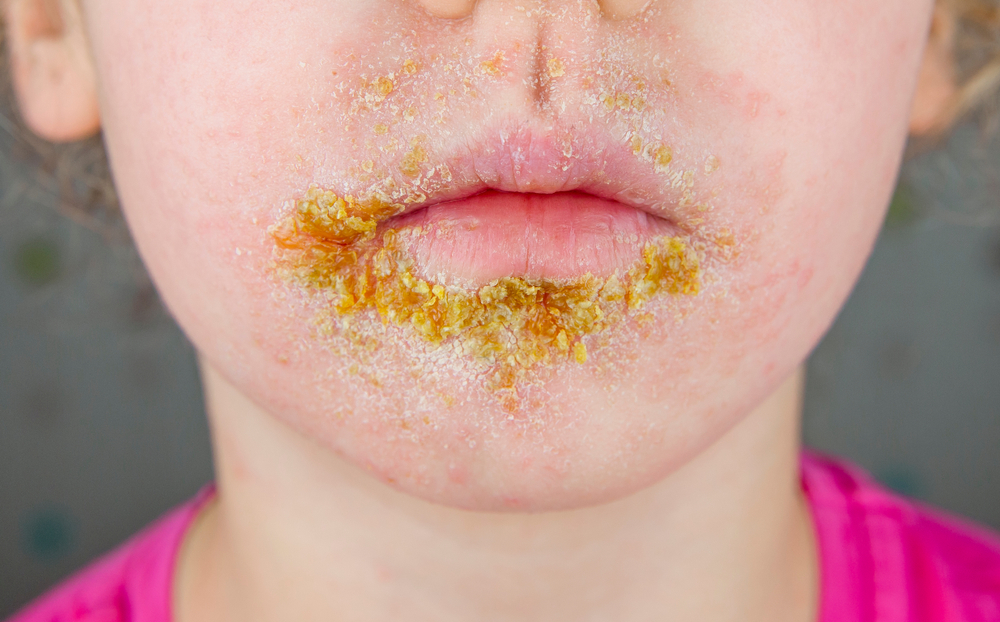 A child has impetigo around their mouth, which may become scarred.