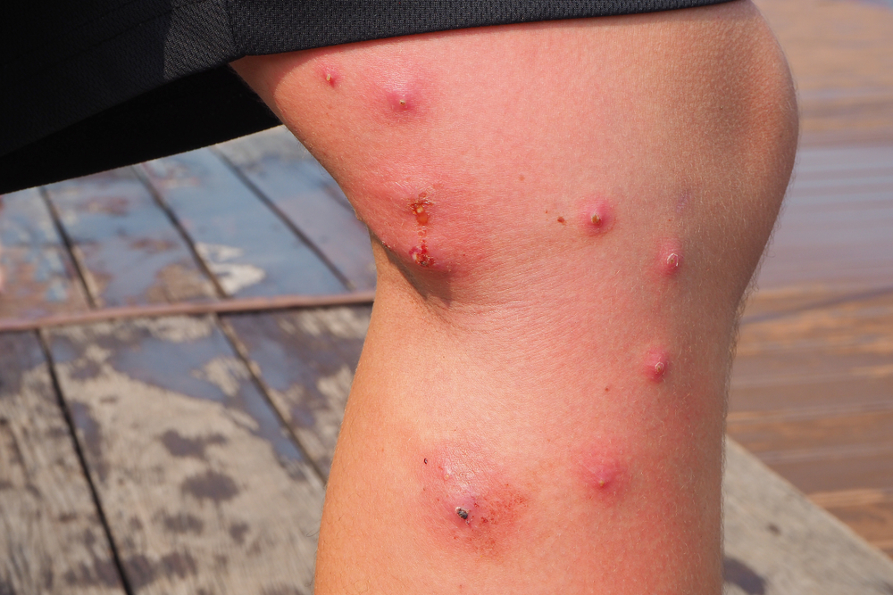 A man's leg with multiple infected mosquito bites
