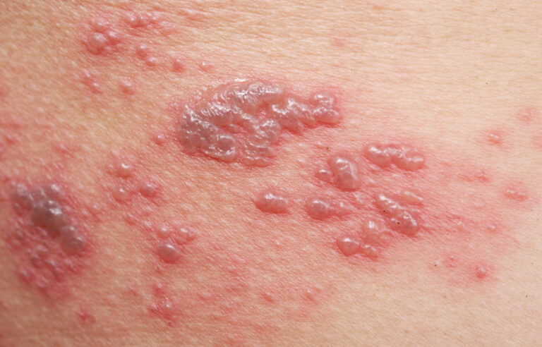 A close up image of a shingles rash, that could be mistaken for another condition