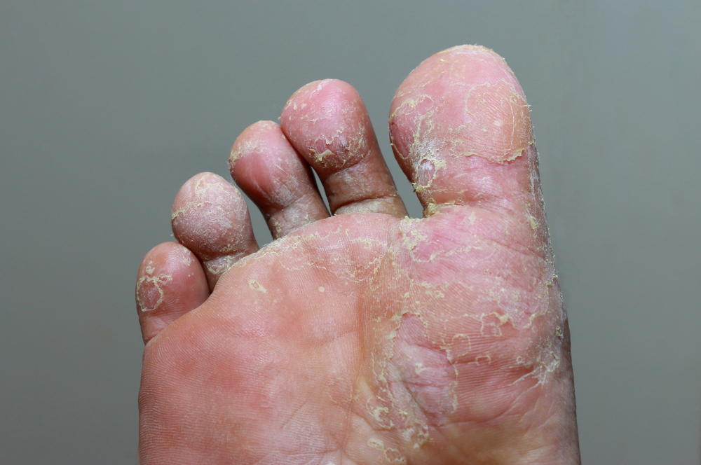 A close up photo of a severe fungal athlete's foot infection that covers most of the foot