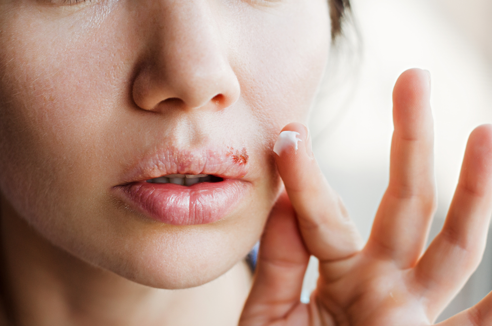 A woman is about to apply cream to her cold sore, which is just above her upper lip to the right.