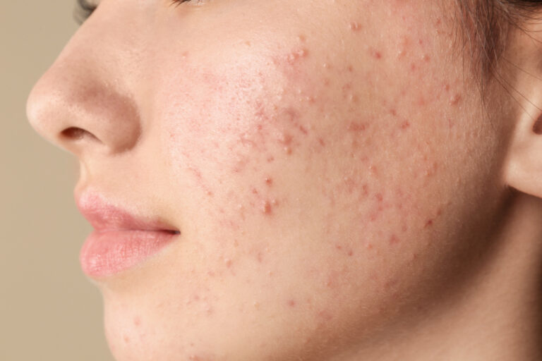 A young woman's face with acne spots and scars.