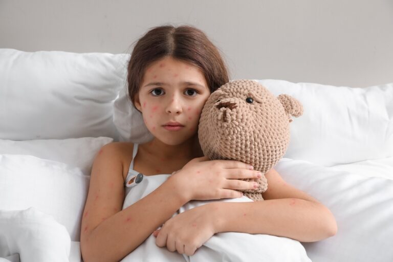 A little girl sits up in bed hugging her teddy bear with a clear chickenpox rash on her face