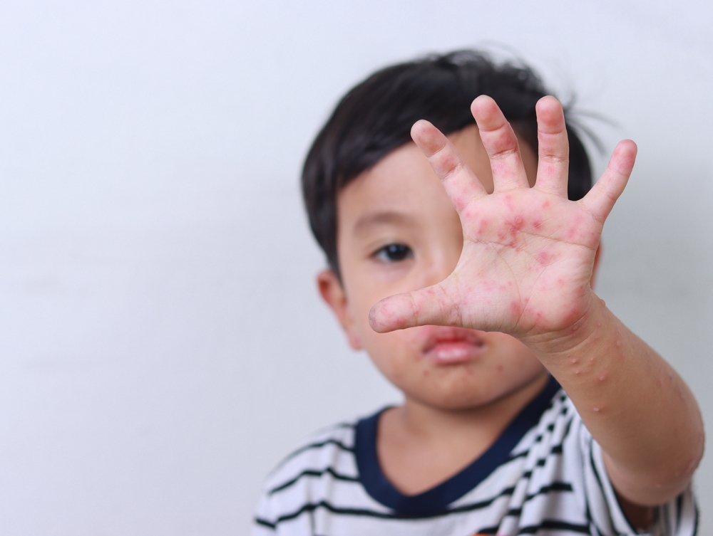 A young boy affected by hand, foot and mouth disease holds up his hand to the camera which shows the typical blisters caused by the illness.