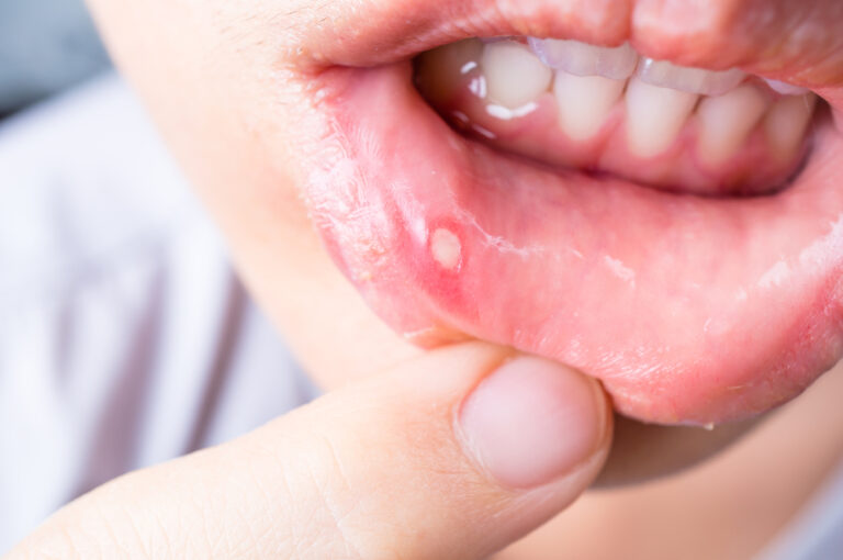 A close-up photo of a person pulling their bottom lip back to show the mouth ulcer they're dealing with.