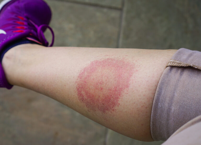 A photo of a woman's leg with the typical bull's-eye rash associated with Lyme disease